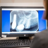 Bespoke Dental Global Service Blurb Implant Turner Canberra