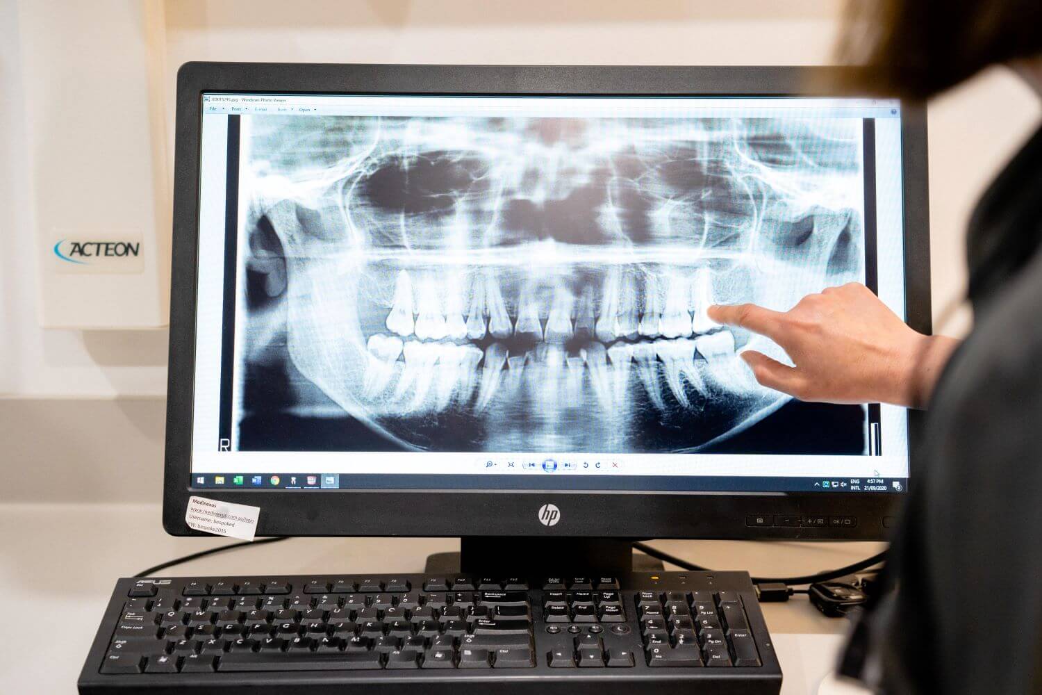 Implant Dentistry Bespoke Dental Turner Canberra