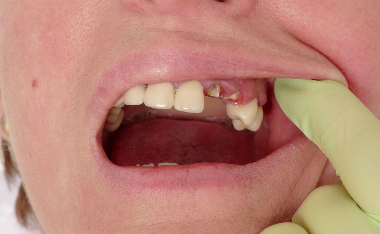 Emergency Dentistry Knocked Out Teeth Bespoke Dental Turner Canberra