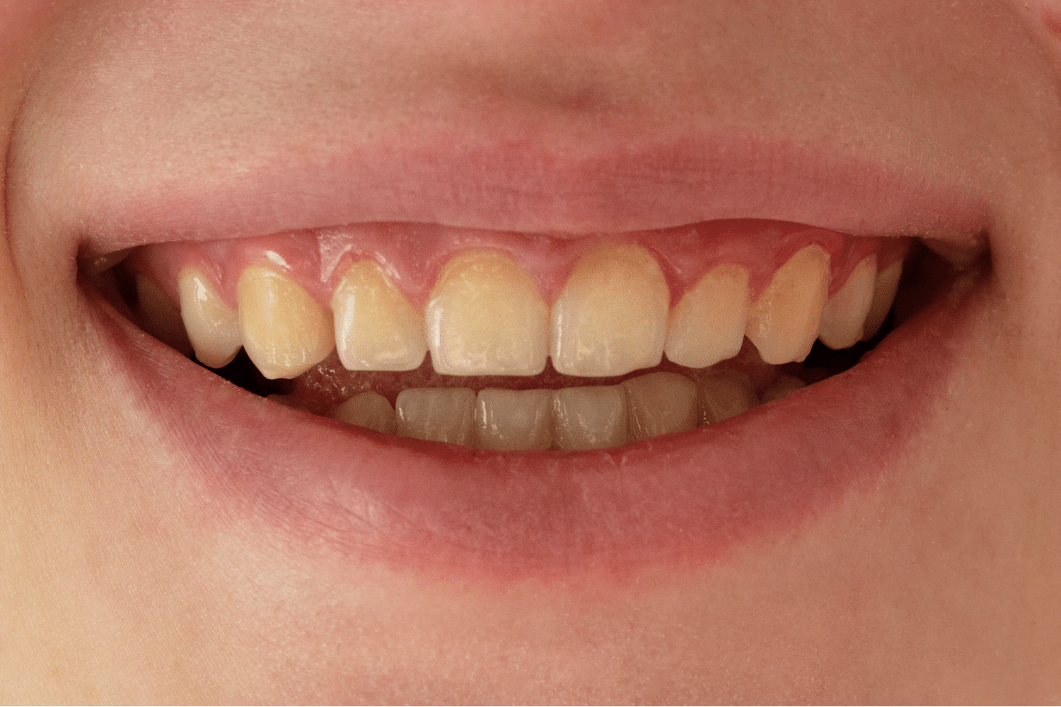 Teeth Discolouration Bespoke Dental Turner Canberra